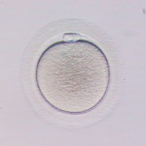 Puncion-folicular-y-asignacion-de-ovocitos Punción folicular y asignación de ovocitos