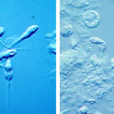 biopsia-testicular Biopsia testicular